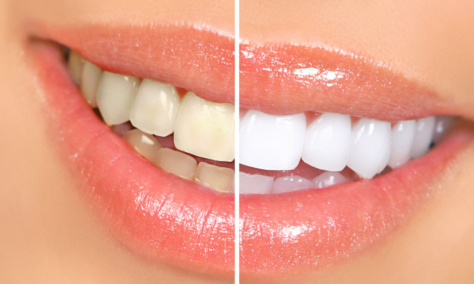 Prestige Teeth whitening beauty salon brossard beauté salon esthetic Rose blanchissement dent